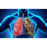 Hiểu biết cơ bản mới về cách ung thư phổi lây lan